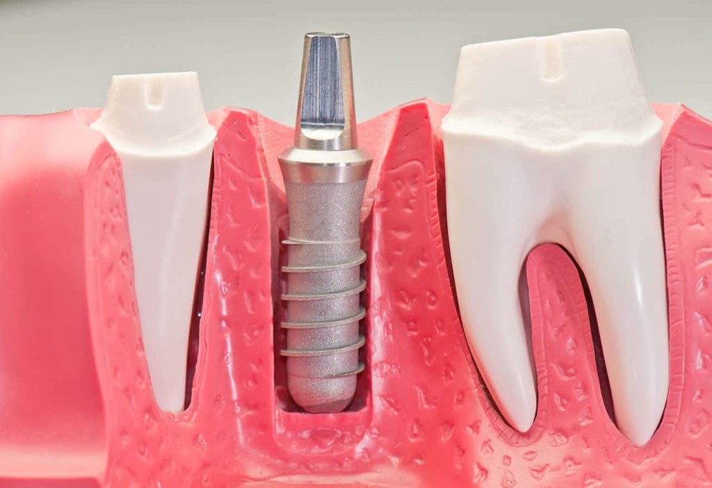 Boeriu Implant Dentistry - Single Tooth Implant