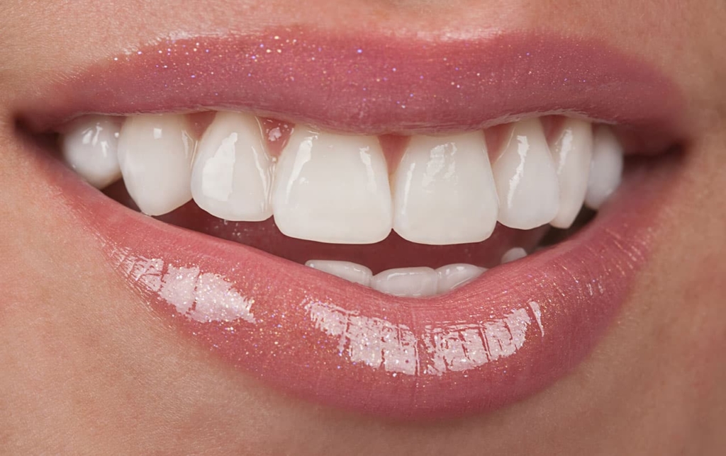 Porcelain Veneers - Boeriu Implant Dentistry - Kitchener Dental Office